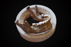 Malocclusion, a legacy of early sedentarism?