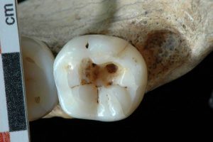 Ancient Dentistry discovery fascinates scientists!