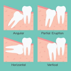 What you need to know about your wisdom tooth extraction