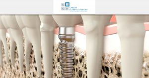 Do I need bone graft to get dental implants? – Cancun Cosmetic Dentistry