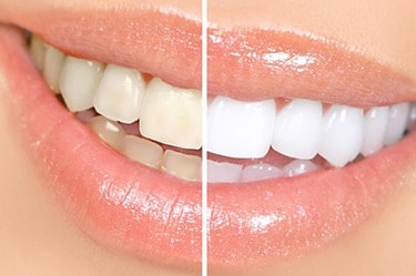 Laser_whitening_before_and_after