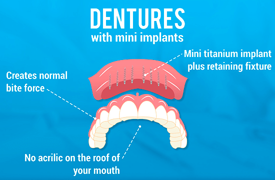 Mini_Implant_dentures_in_Cancun