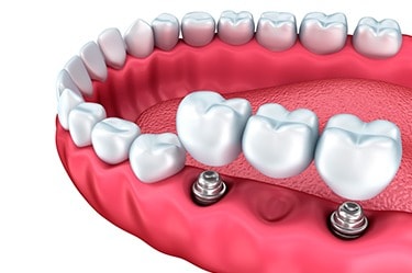 dental-implant-price-Cancun-3