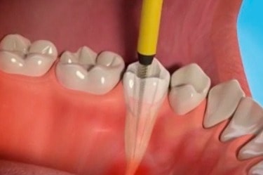 root-canal-cancun-pain-tooth-3