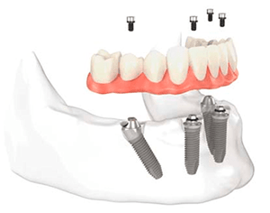 dentures with implants