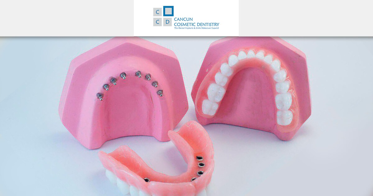 What's the procedure for Snap in Dentures?